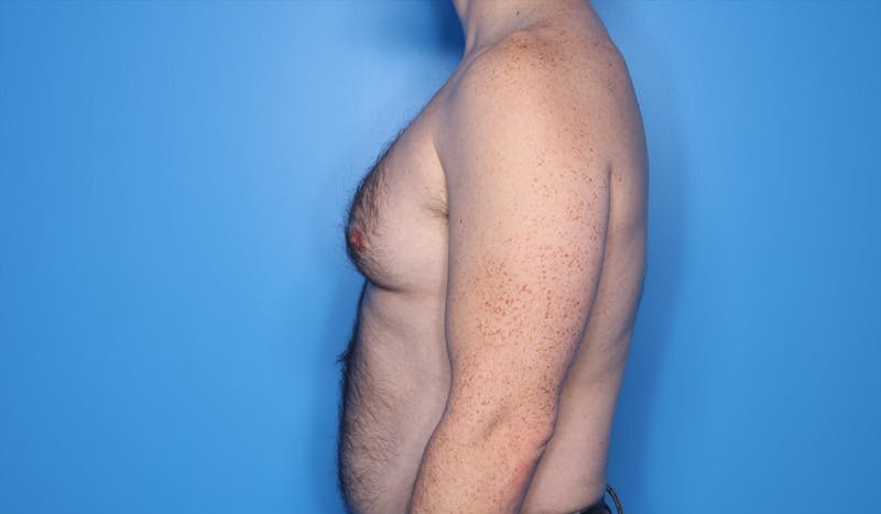 Gynecomastia (Male Breast Reduction) Before & After Gallery - Patient 389721 - Image 3