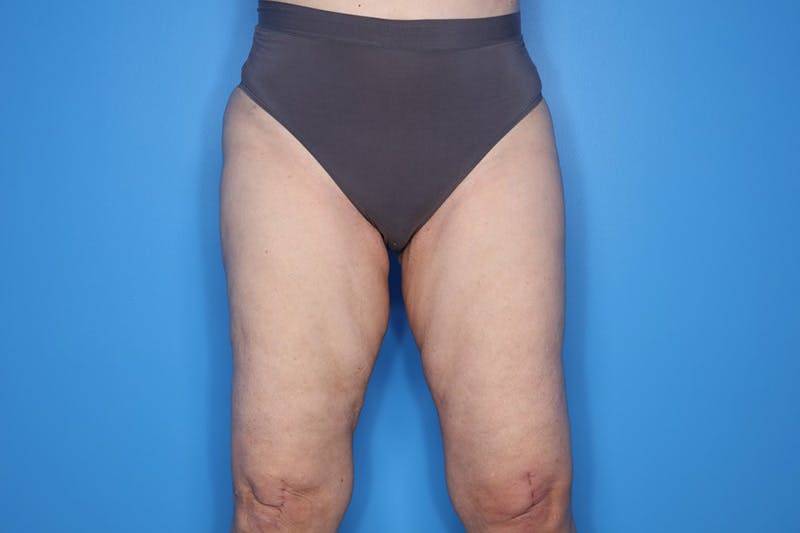 Thigh Lift Before & After Gallery - Patient 155731 - Image 1