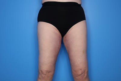 Thigh Lift Before & After Gallery - Patient 155731 - Image 2