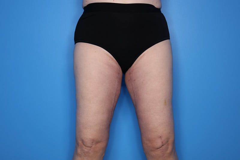 Thigh Lift Before & After Gallery - Patient 155731 - Image 2