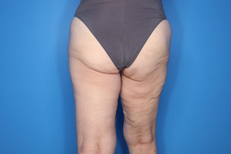 Thigh Lift Before & After Gallery - Patient 155731 - Image 3