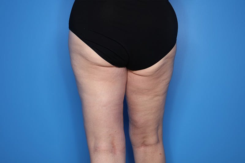 Thigh Lift Before & After Gallery - Patient 155731 - Image 4