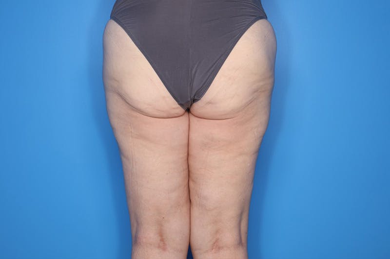Thigh Lift Before & After Gallery - Patient 155731 - Image 5