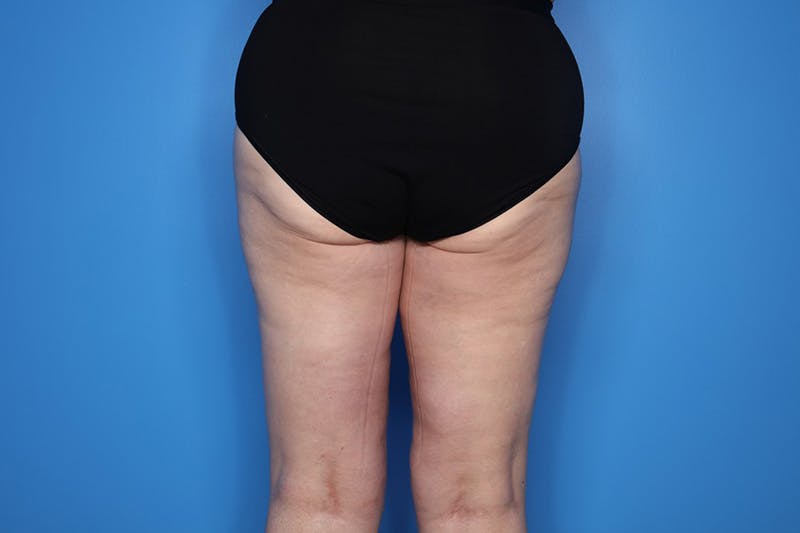 Thigh Lift Before & After Gallery - Patient 155731 - Image 6