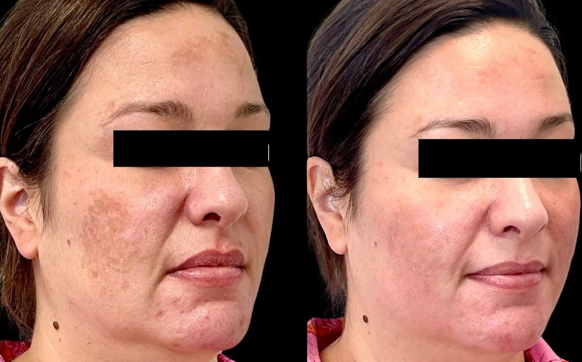 Sciton® Halo Before & After Gallery - Patient 397916 - Image 2