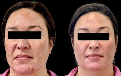 Sciton® Halo Before & After Gallery - Patient 397916 - Image 1