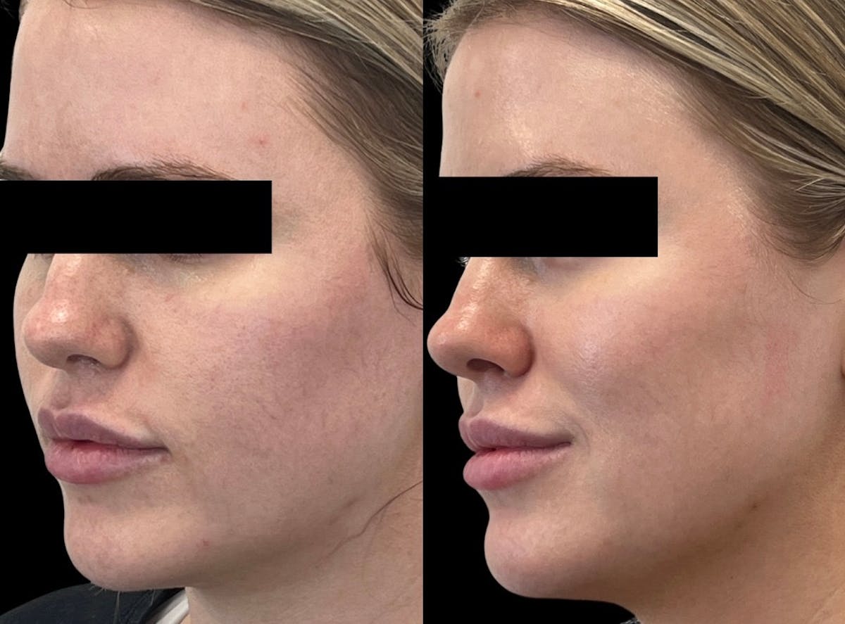 Clear + Brilliant® Before & After Gallery - Patient 368035 - Image 1