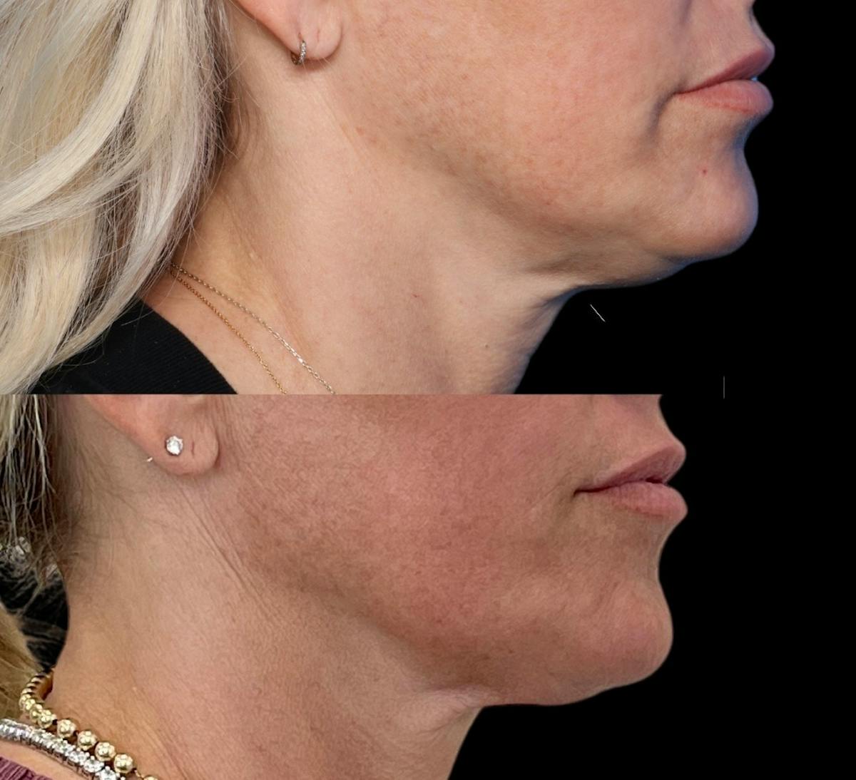 Morpheus8® Before & After Gallery - Patient 799792 - Image 1