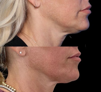 Morpheus8® Before & After Gallery - Patient 799792 - Image 1