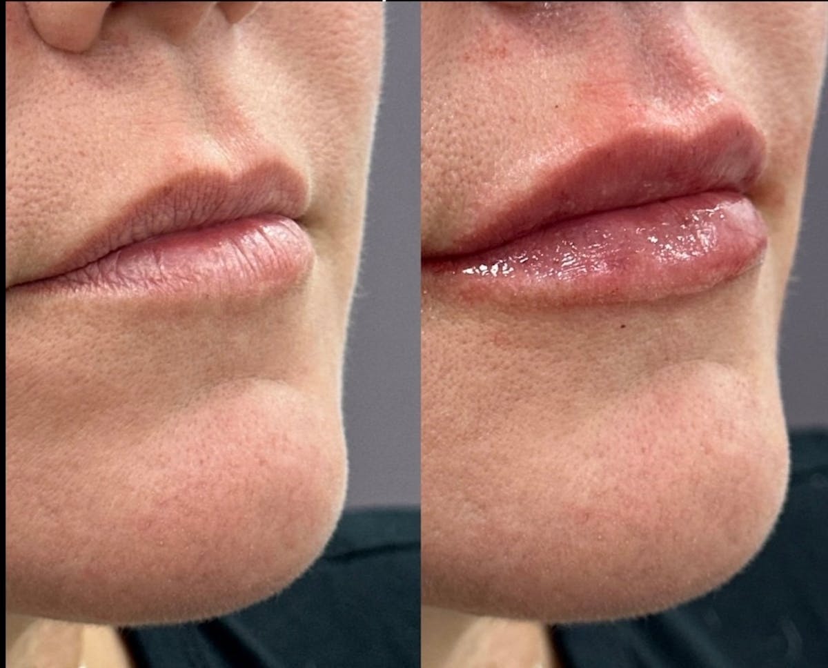 Juvéderm® Before & After Gallery - Patient 404512 - Image 1