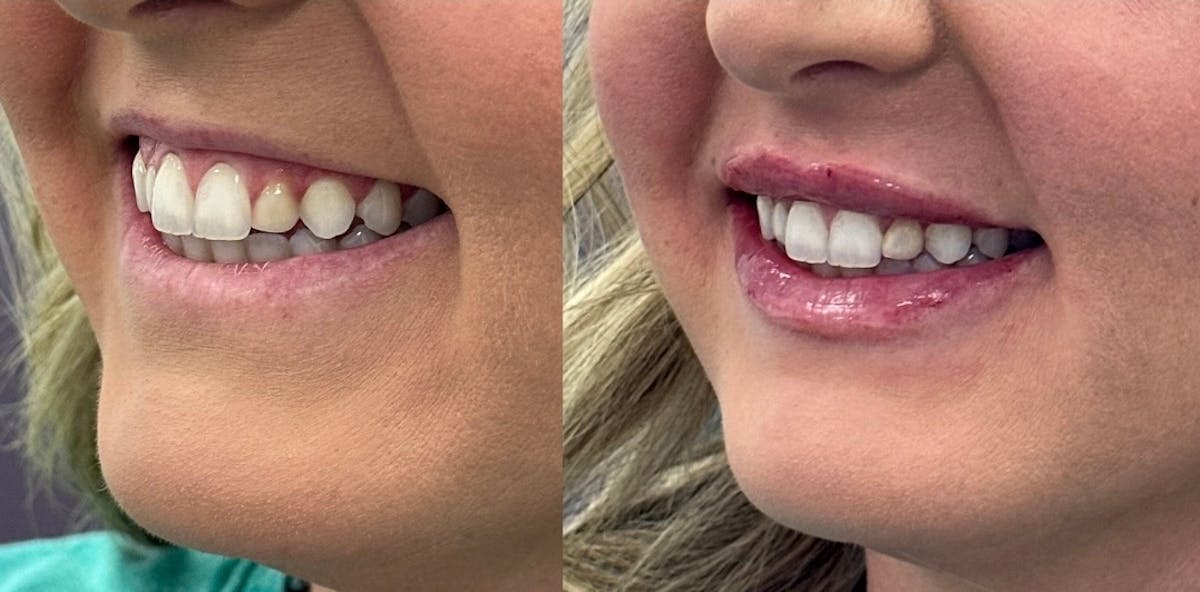 Juvéderm® Before & After Gallery - Patient 195975 - Image 1