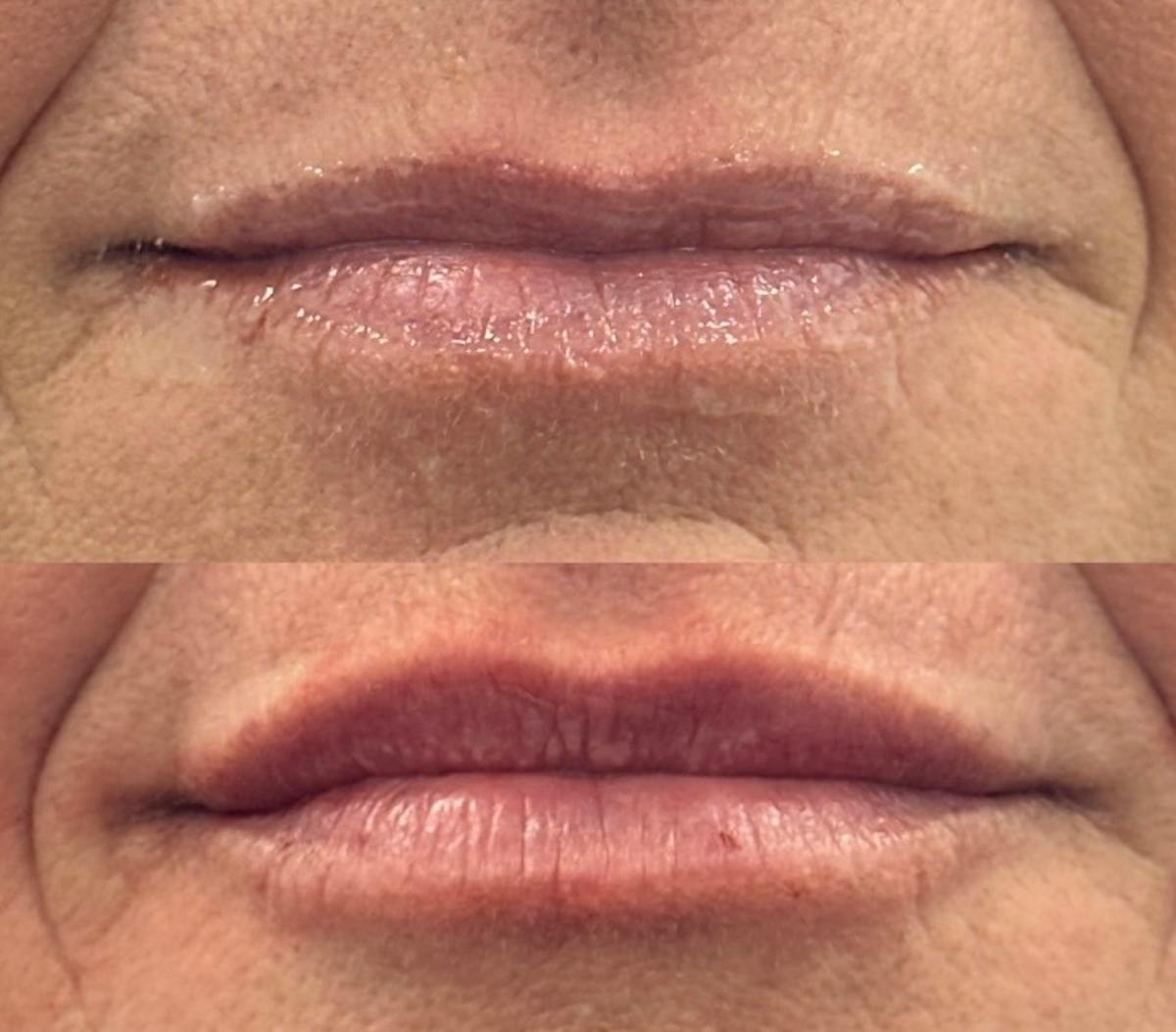 Lip Filler Before & After Gallery - Patient 311947 - Image 1