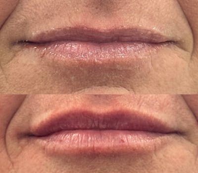 Lip Filler Before & After Gallery - Patient 311947 - Image 1