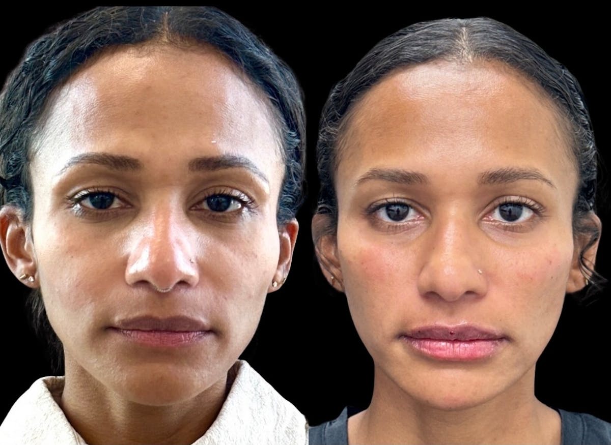 Jawline Filler Before & After Gallery - Patient 233681 - Image 1