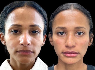 Juvéderm® Before & After Gallery - Patient 316649 - Image 1