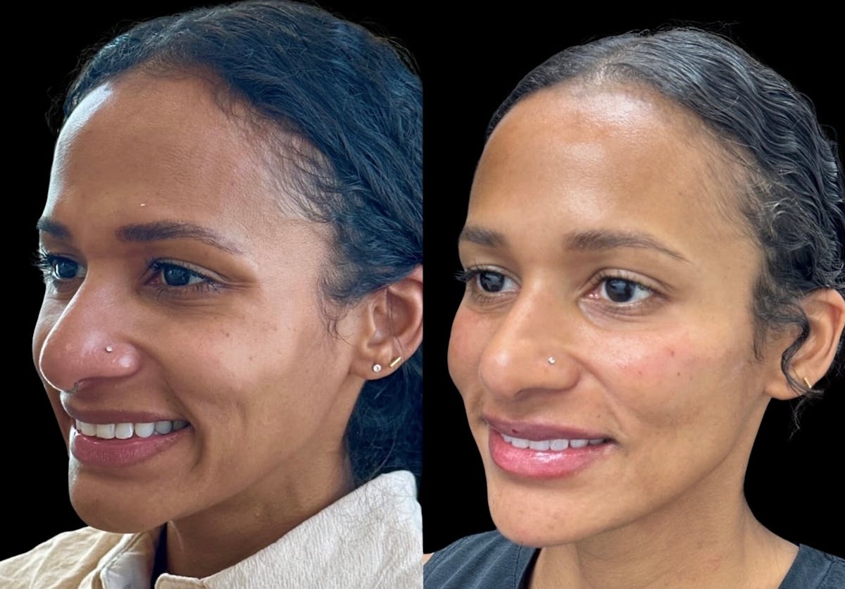 Jawline Filler Before & After Gallery - Patient 233681 - Image 2