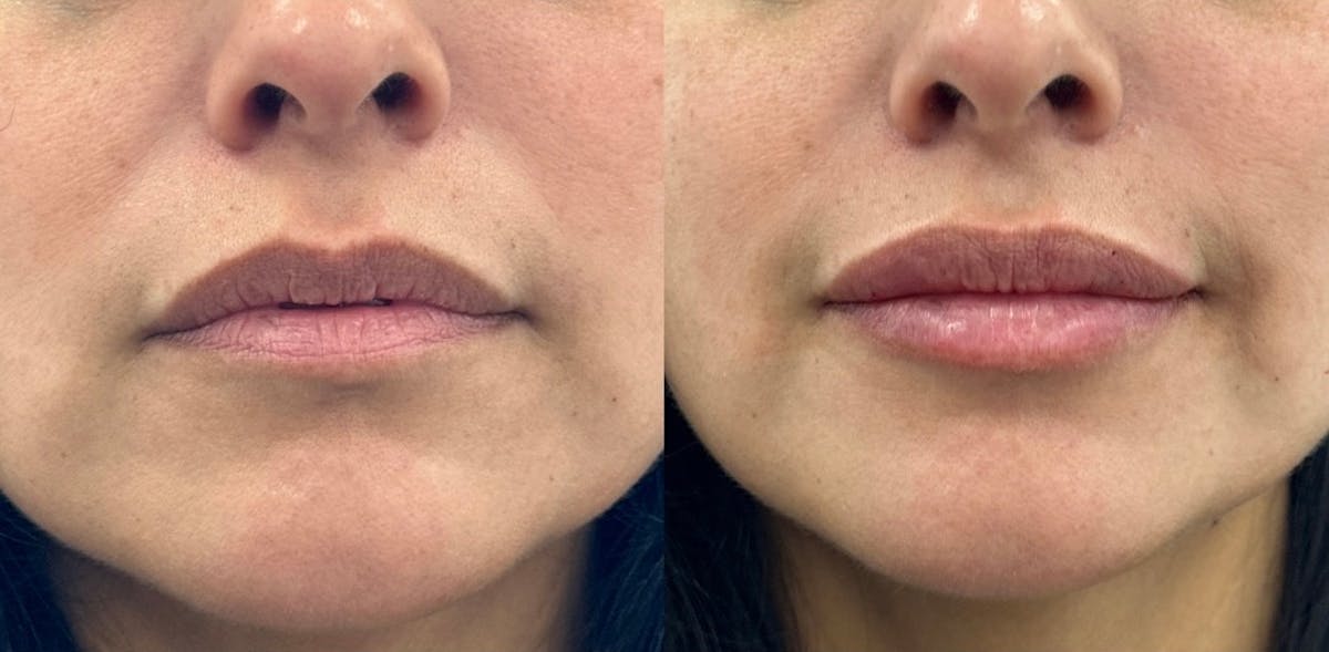 Juvéderm® Before & After Gallery - Patient 100795 - Image 1