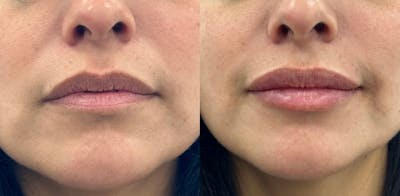 Juvéderm® Before & After Gallery - Patient 100795 - Image 1