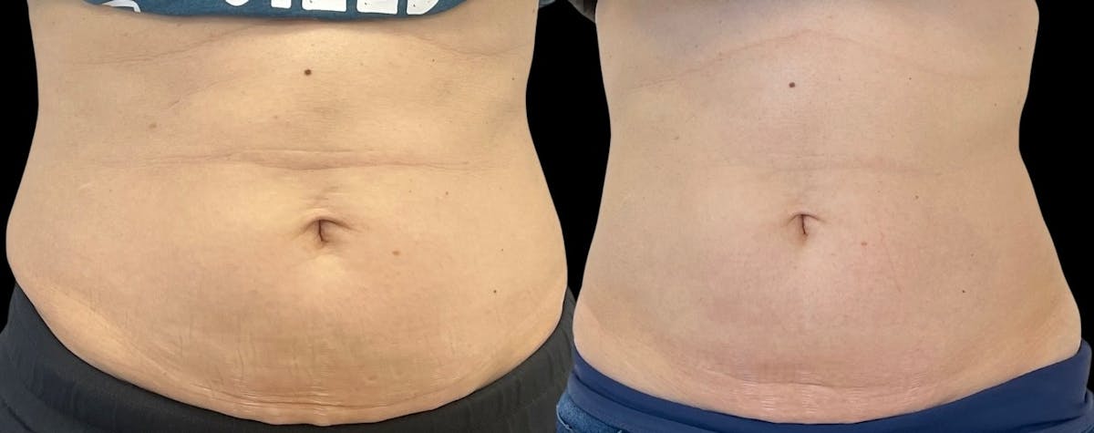 Morpheus8® Before & After Gallery - Patient 101465 - Image 1