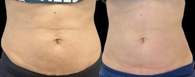 Morpheus8® Before & After Gallery - Patient 101465 - Image 1