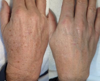 Sciton® BBL Hero Before & After Gallery - Patient 374577 - Image 1