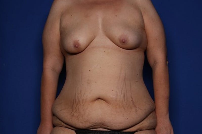 Mommy Makeover Before & After Gallery - Patient 342168 - Image 1