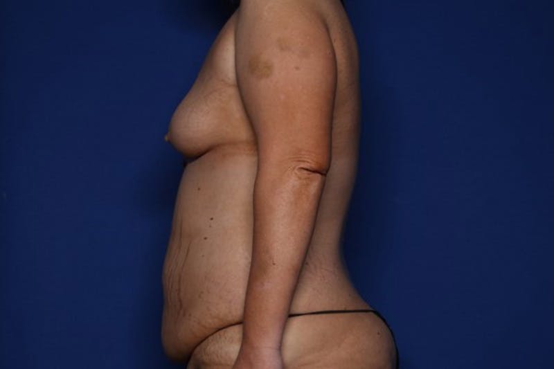 Mommy Makeover Before & After Gallery - Patient 342168 - Image 3