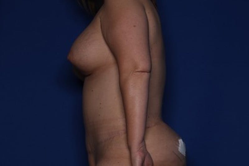 Mommy Makeover Before & After Gallery - Patient 342168 - Image 4