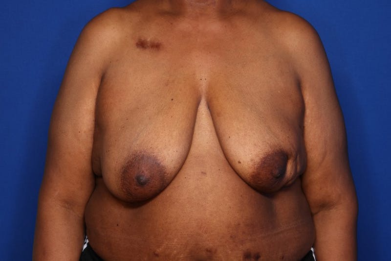 Body Lift Before & After Gallery - Patient 352837 - Image 1