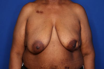 Body Lift Before & After Gallery - Patient 352837 - Image 1