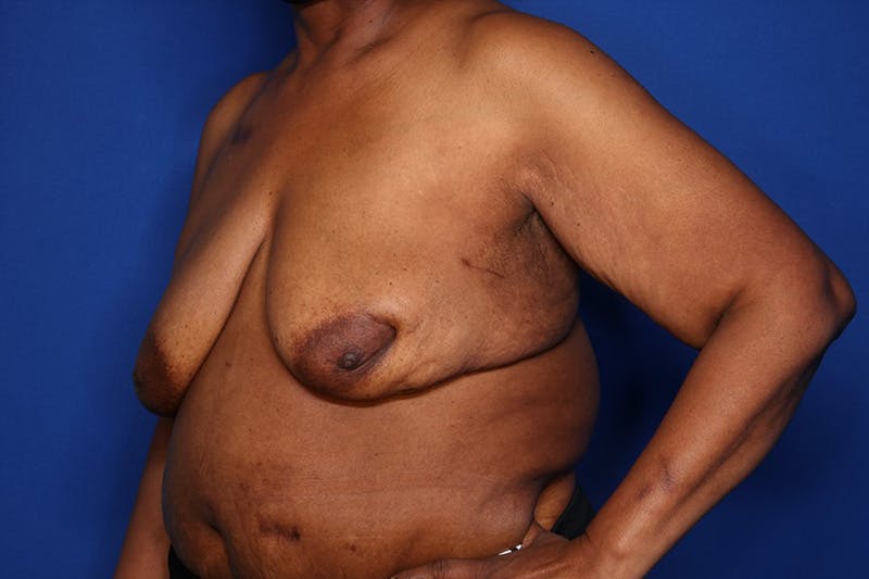 Body Lift Before & After Gallery - Patient 352837 - Image 3