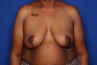 Body Lift Before & After Gallery - Patient 352837 - Image 2