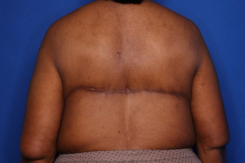 Body Lift Before & After Gallery - Patient 352837 - Image 6