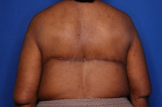Body Lift Before & After Gallery - Patient 352837 - Image 6