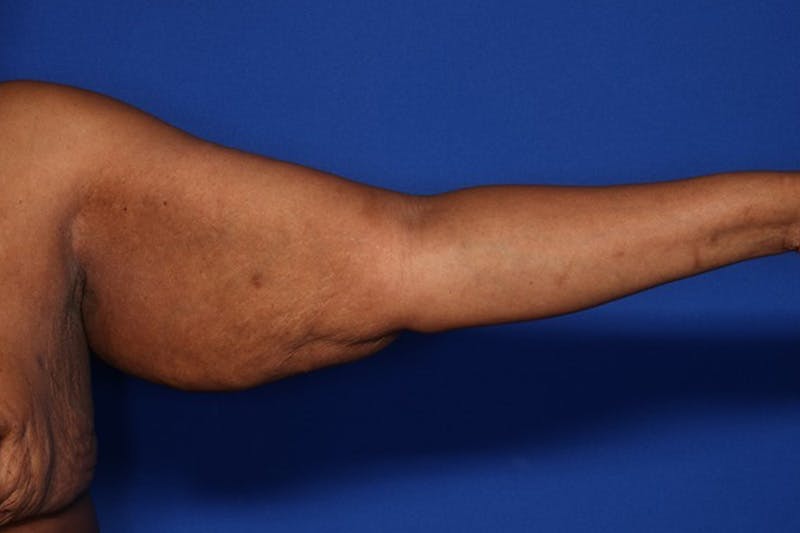 Body Lift Before & After Gallery - Patient 352837 - Image 7