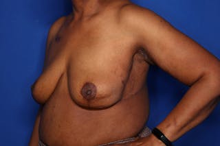 Body Lift Before & After Gallery - Patient 352837 - Image 4