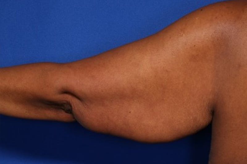 Body Lift Before & After Gallery - Patient 352837 - Image 9