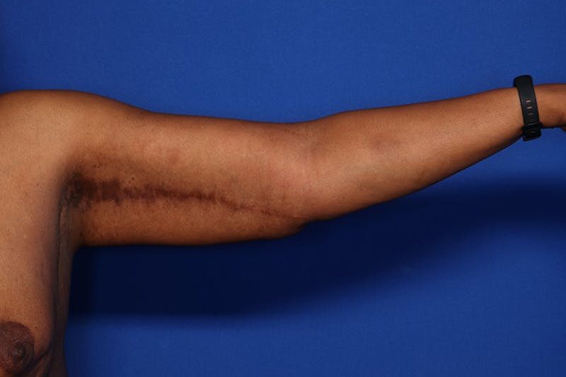 Body Lift Before & After Gallery - Patient 352837 - Image 8