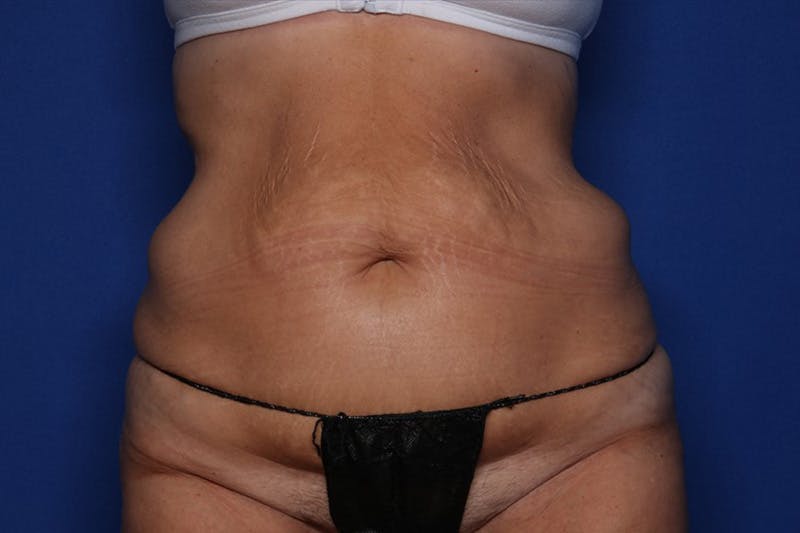 Body Lift Before & After Gallery - Patient 385536 - Image 1