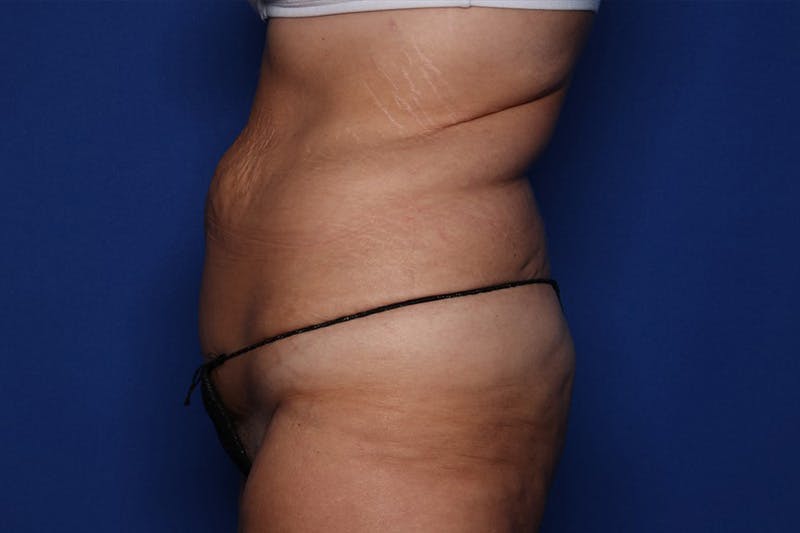 Body Lift Before & After Gallery - Patient 385536 - Image 3