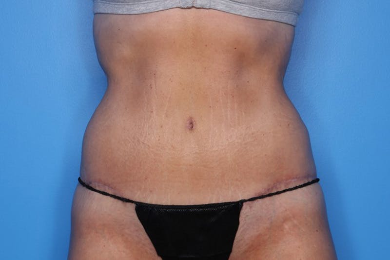 Body Lift Before & After Gallery - Patient 385536 - Image 2