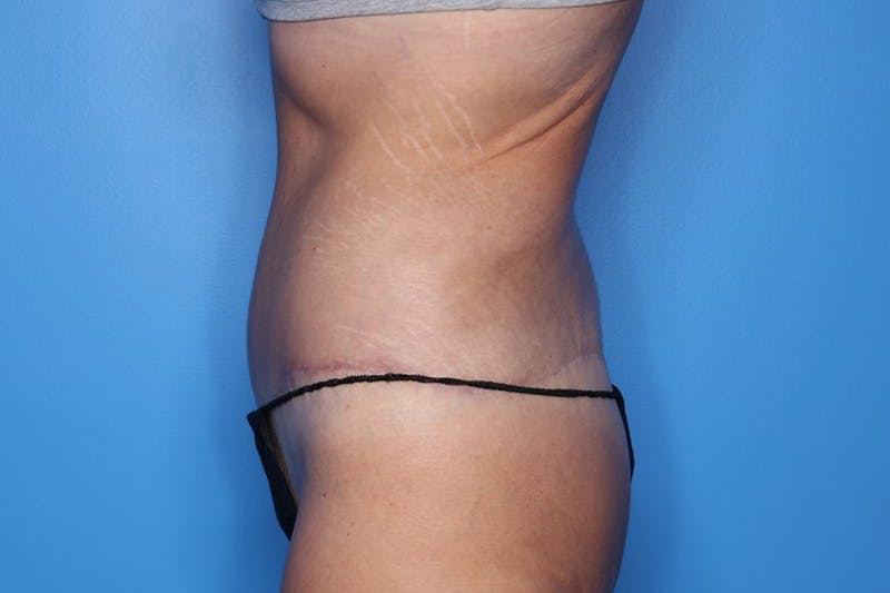 Body Lift Before & After Gallery - Patient 385536 - Image 4