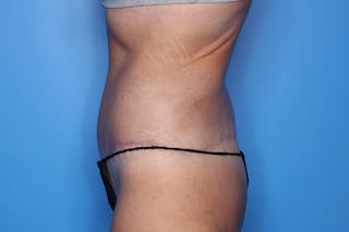 Body Lift Before & After Gallery - Patient 385536 - Image 4