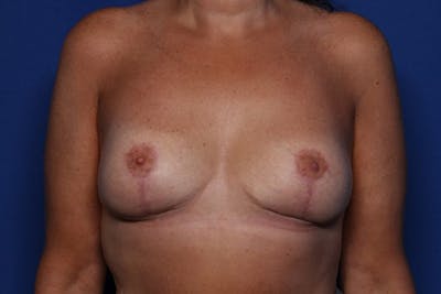 Breast Lift Before & After Gallery - Patient 283594 - Image 2