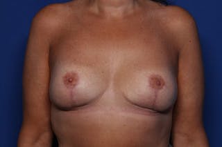Breast Lift Before & After Gallery - Patient 283594 - Image 2