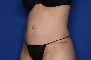 Tummy Tuck Before & After Gallery - Patient 674073 - Image 4