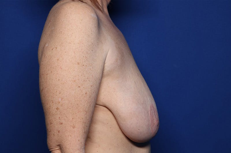 Breast Augmentation + Lift Before & After Gallery - Patient 356684 - Image 5