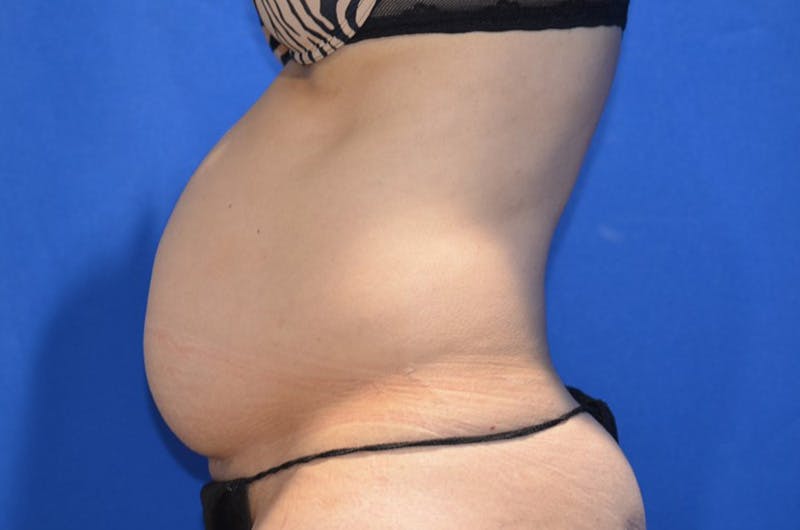Tummy Tuck Before & After Gallery - Patient 674073 - Image 5