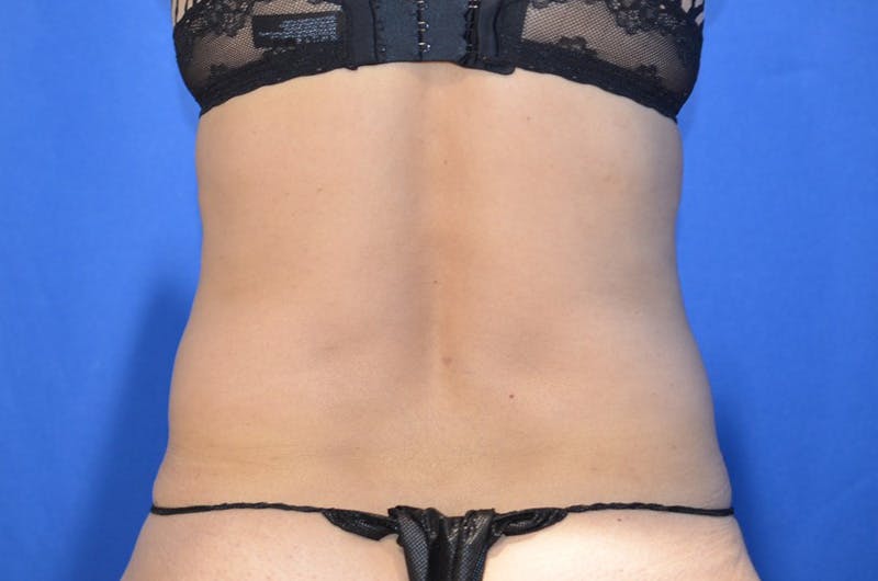 Tummy Tuck Before & After Gallery - Patient 674073 - Image 7