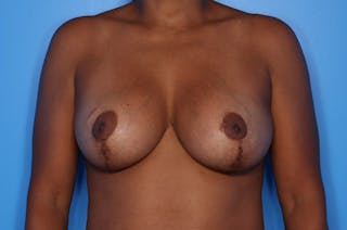 Implant Exchange Before & After Gallery - Patient 189492 - Image 2